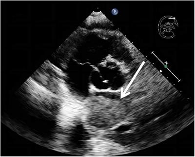 Case Report: Lung cancer with rare cardiac and other multiple metastases